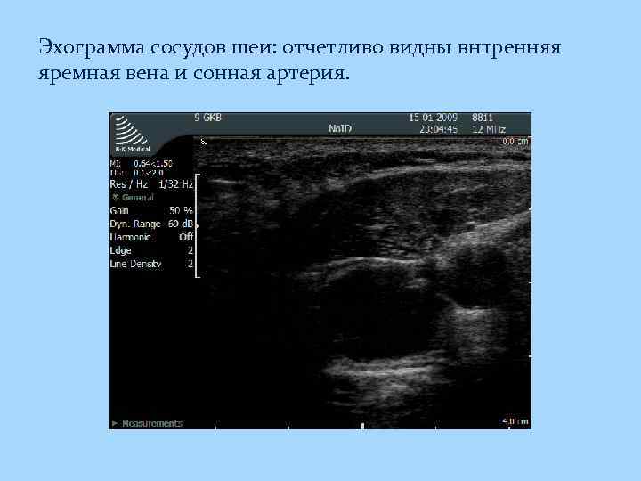 Эхограмма сосудов шеи: отчетливо видны внтренняя яремная вена и сонная артерия. 
