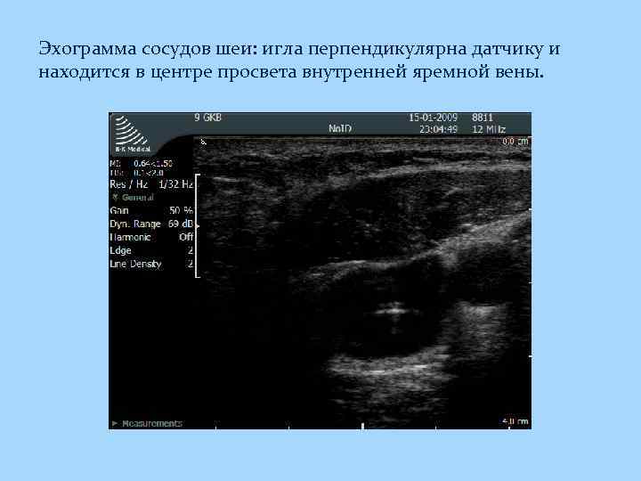 Эхограмма сосудов шеи: игла перпендикулярна датчику и находится в центре просвета внутренней яремной вены.