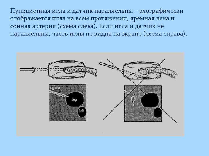 Пункционная игла и датчик параллельны – эхографически отображается игла на всем протяжении, яремная вена