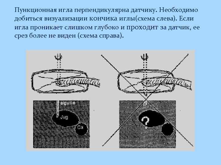 Пункционная игла перпендикулярна датчику. Необходимо добиться визуализации кончика иглы(схема слева). Если игла проникает слишком