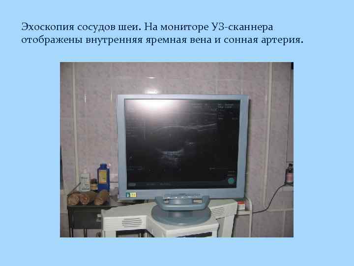 Эхоскопия сосудов шеи. На мониторе УЗ-сканнера отображены внутренняя яремная вена и сонная артерия. 