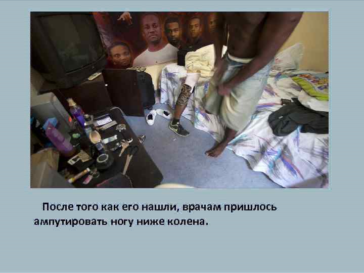  После того как его нашли, врачам пришлось ампутировать ногу ниже колена. 