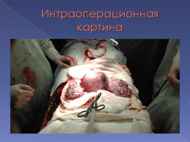 Интраоперационная картина 