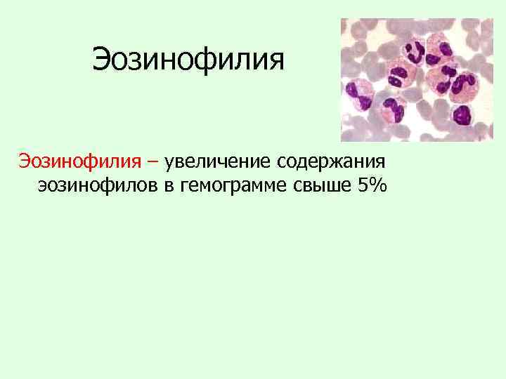 Эозинофилия – увеличение содержания эозинофилов в гемограмме свыше 5% 