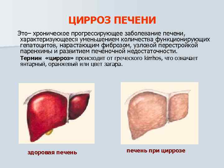 ЦИРРОЗ ПЕЧЕНИ Это– хроническое прогрессирующее заболевание печени, характеризующееся уменьшением количества функционирующих гепатоцитов, нарастающим фиброзом,