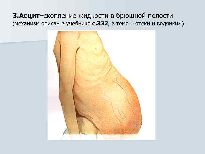 3. Асцит–скопление жидкости в брюшной полости (механизм описан в учебнике с. 332, в теме