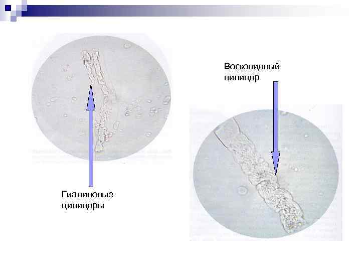 Восковидный цилиндр Гиалиновые цилиндры 