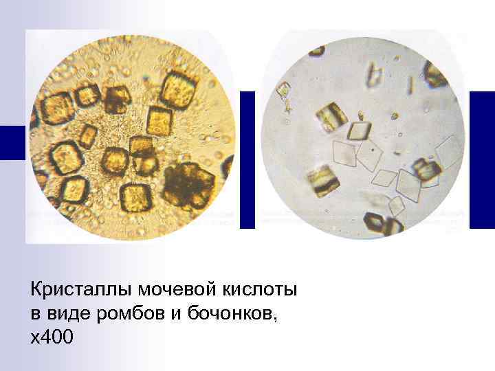 Кристаллы мочевой кислоты в виде ромбов и бочонков, х400 