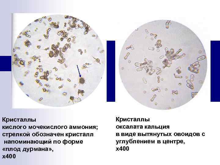 Микроскопия осадка мочи фото с описанием