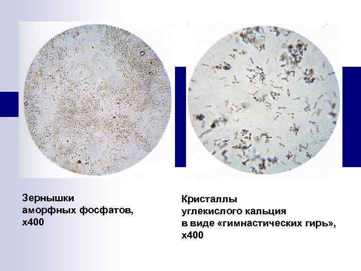 Зернышки аморфных фосфатов, х400 Кристаллы углекислого кальция в виде «гимнастических гирь» , х400 