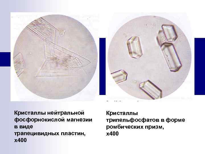 Кристаллы нейтральной фосфорнокислой магнезии в виде трапецивидных пластин, х400 Кристаллы трипельфосфатов в форме ромбических