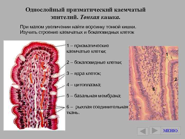 Пролиферация призматического эпителия на фоне воспаления