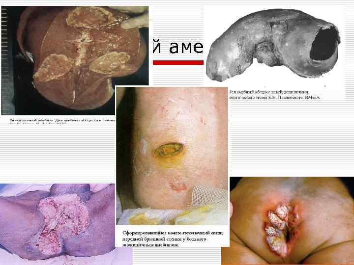 Внекишечный амебиаз 