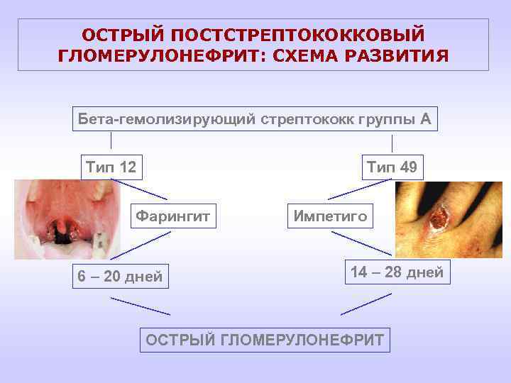 ОСТРЫЙ ПОСТСТРЕПТОКОККОВЫЙ ГЛОМЕРУЛОНЕФРИТ: СХЕМА РАЗВИТИЯ Бета-гемолизирующий стрептококк группы А Тип 12 Тип 49 Фарингит