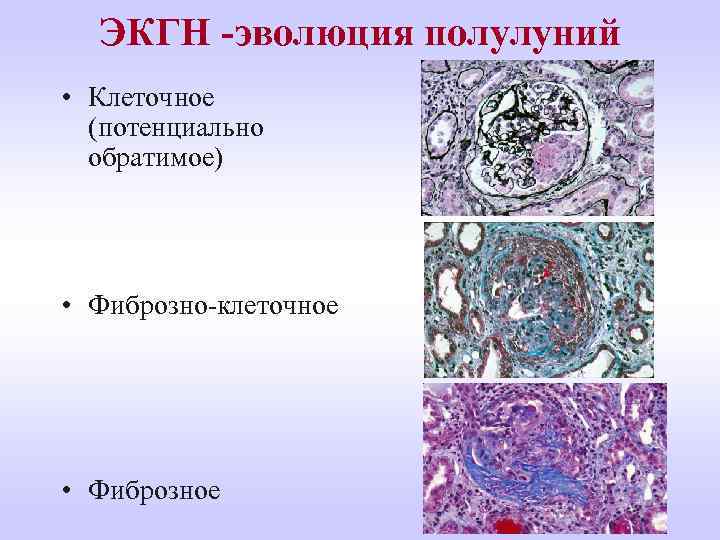 ЭКГН -эволюция полулуний • Клеточное (потенциально обратимое) • Фиброзно-клеточное • Фиброзное 
