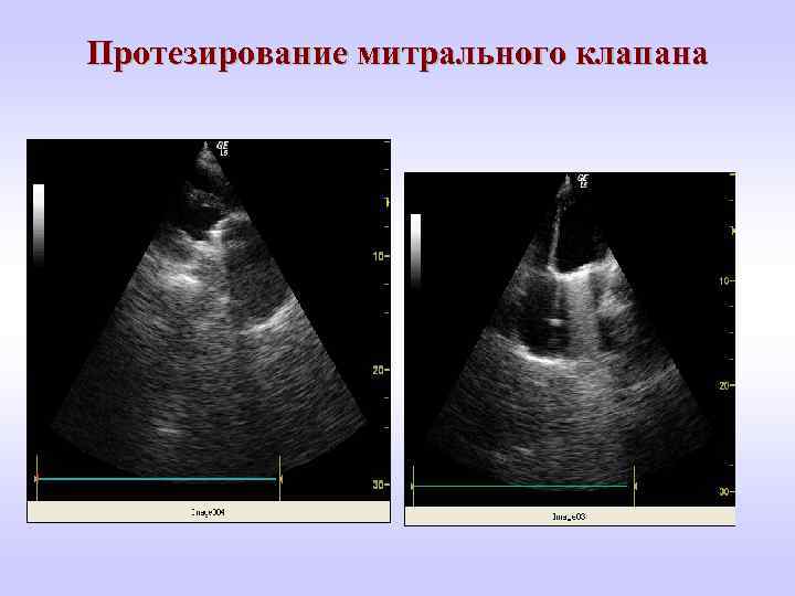 Протезирование митрального клапана 