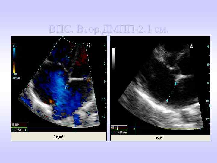 ВПС. Втор. ДМПП-2. 1 см. 