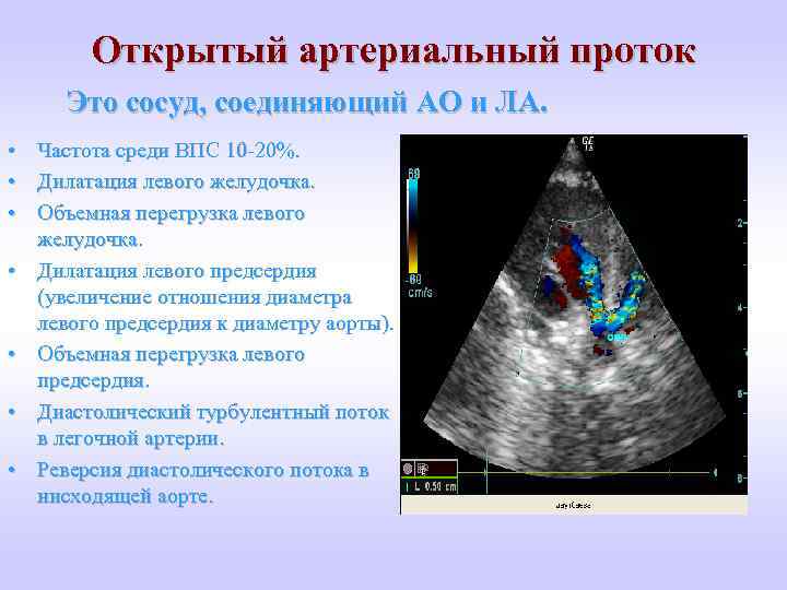 Открытый артериальный проток Это сосуд, cоединяющий АО и ЛА. • • Частота среди ВПС
