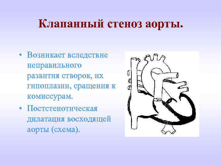 Клапанный стеноз аорты. • Возникает вследствие неправильного развития створок, их гипоплазии, сращения к комиссурам.