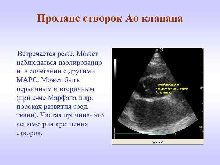 Пролапс створок Ао клапана Встречается реже. Может наблюдаться изолированно и в сочетании с другими