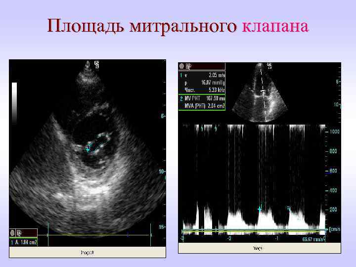Площадь митрального клапана 