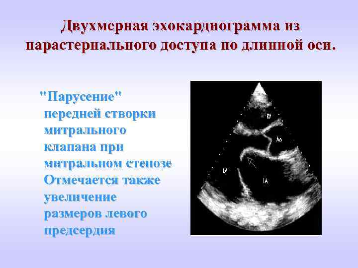 Двухмерная эхокардиограмма из парастернального доступа по длинной оси. "Парусение" передней створки митрального клапана при