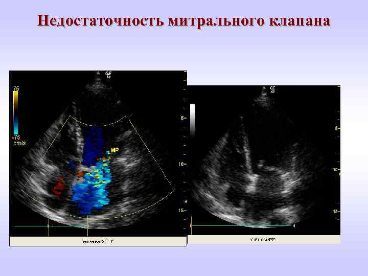 Недостаточность митрального клапана 