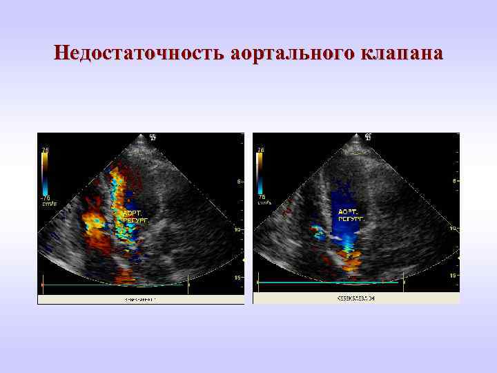 Недостаточность аортального клапана 