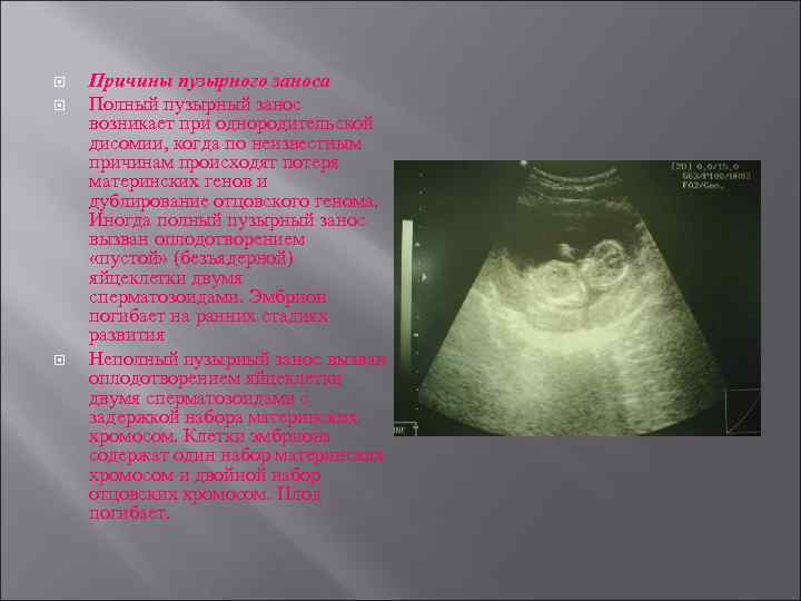  Причины пузырного заноса Полный пузырный занос возникает при однородительской дисомии, когда по неизвестным