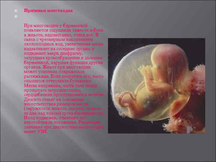  Признаки многоводия При многоводии у беременной появляются ощущения тяжести и боли в животе,
