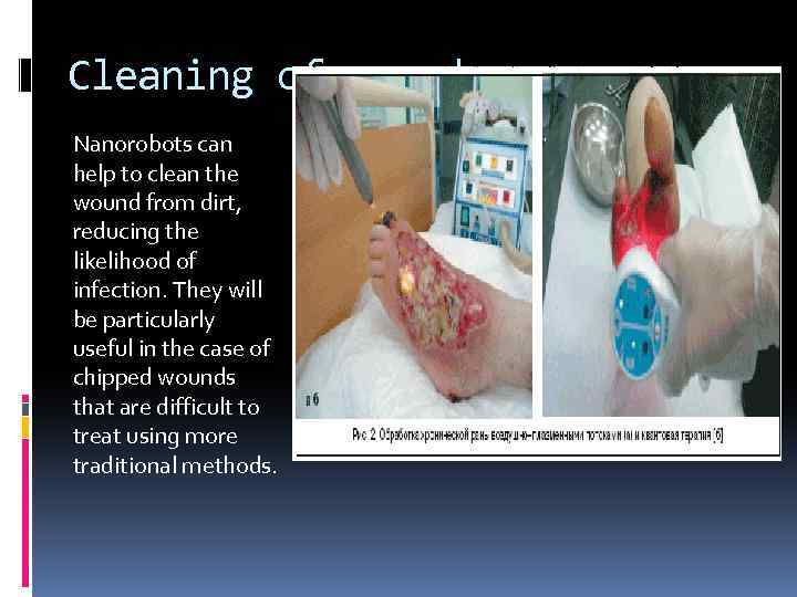 Cleaning of wounds Nanorobots can help to clean the wound from dirt, reducing the