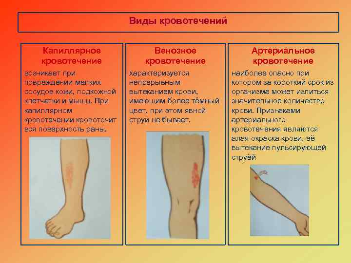 Виды кровотечений Капиллярное кровотечение Венозное кровотечение Артериальное кровотечение возникает при повреждении мелких сосудов кожи,