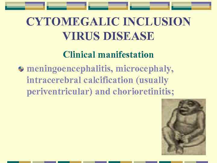 CYTOMEGALIC INCLUSION VIRUS DISEASE Clinical manifestation meningoencephalitis, microcephaly, intracerebral calcification (usually periventricular) and chorioretinitis;
