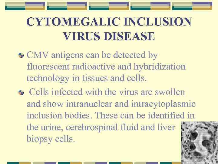 CYTOMEGALIC INCLUSION VIRUS DISEASE CMV antigens can be detected by fluorescent radioactive and hybridization