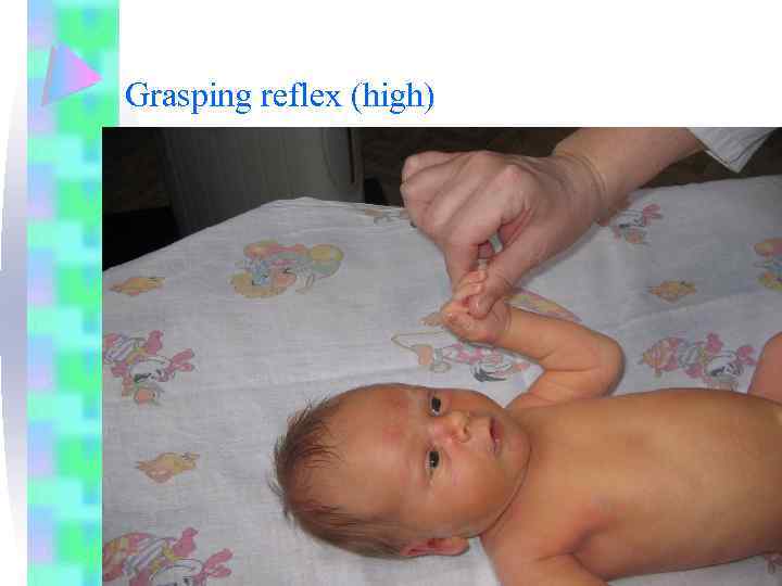 Grasping reflex (high) 