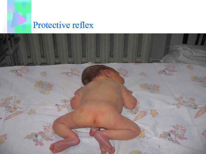 Protective reflex 