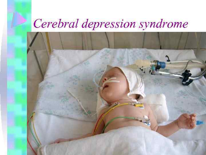 Cerebral depression syndrome 