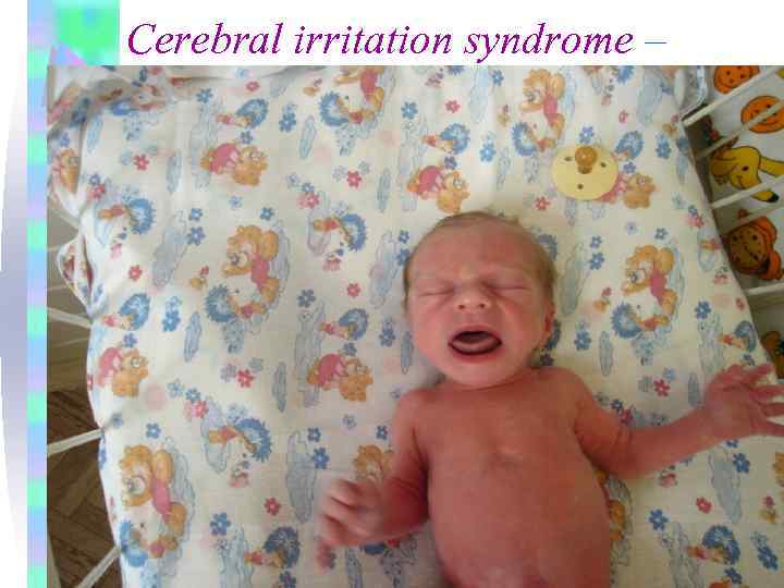 Cerebral irritation syndrome – 