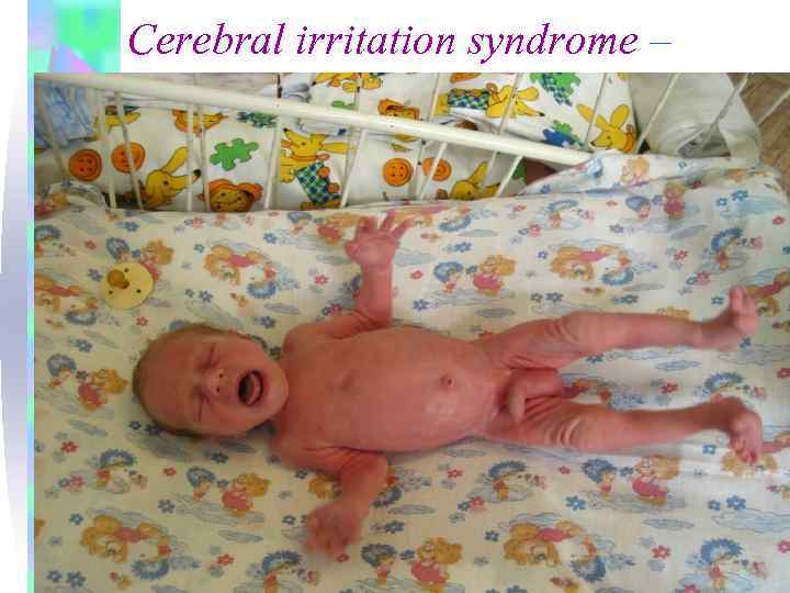 Cerebral irritation syndrome – 