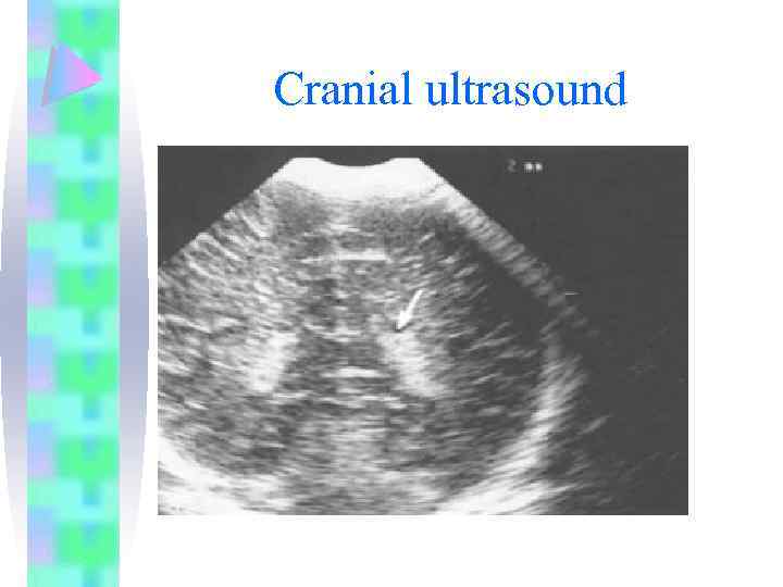 Cranial ultrasound 