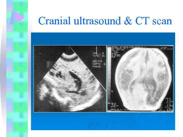 Cranial ultrasound & CT scan 