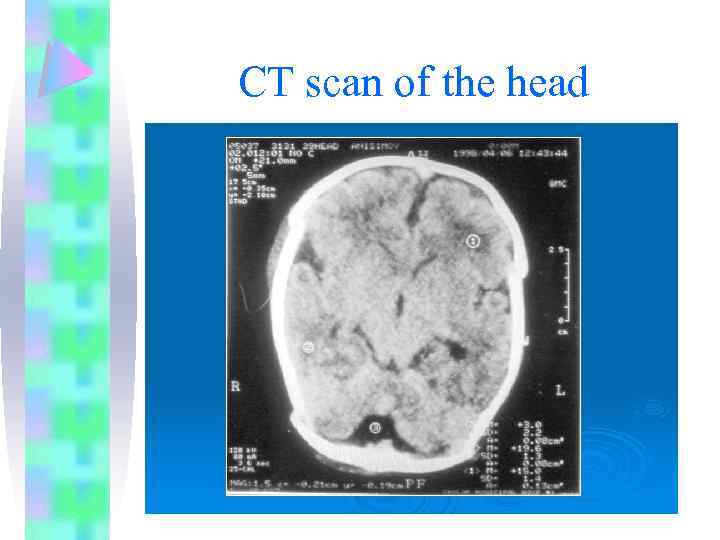 CT scan of the head 