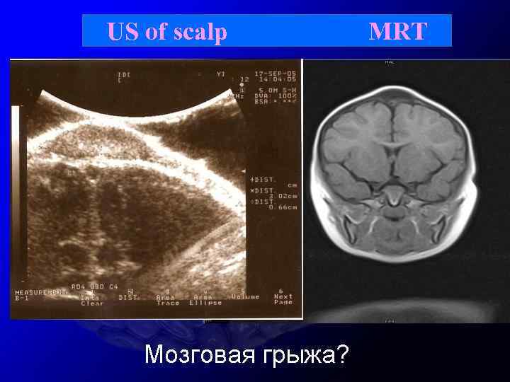 US of scalp MRT 