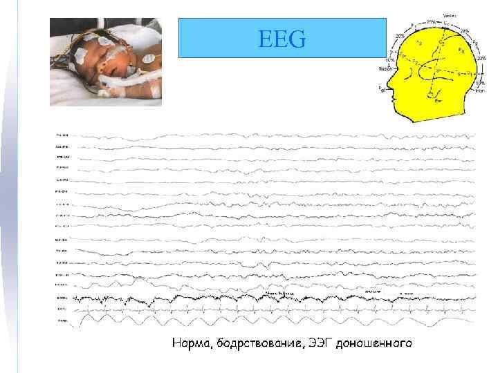 EEG 