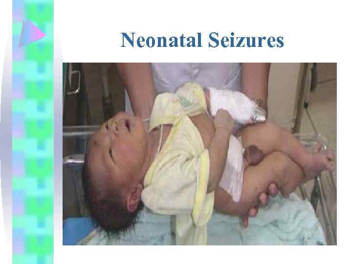 Neonatal Seizures 