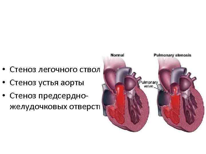  • Стеноз легочного ствола • Стеноз устья аорты • Стеноз предсердножелудочковых отверстий 