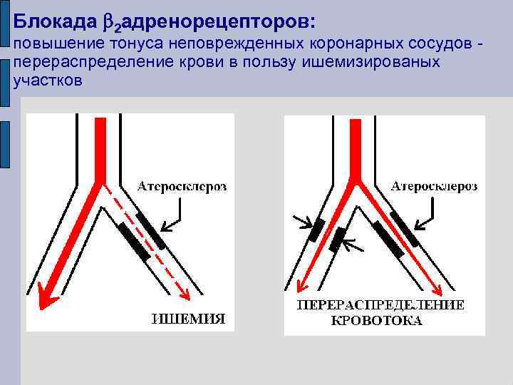 Блокада 2 адренорецепторов: повышение тонуса неповрежденных коронарных сосудов перераспределение крови в пользу ишемизированых участков