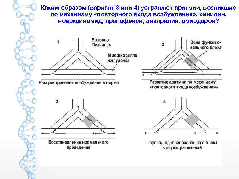 Каким образом (вариант 3 или 4) устраняют аритмии, возникшие по механизму «повторного входа возбуждения»