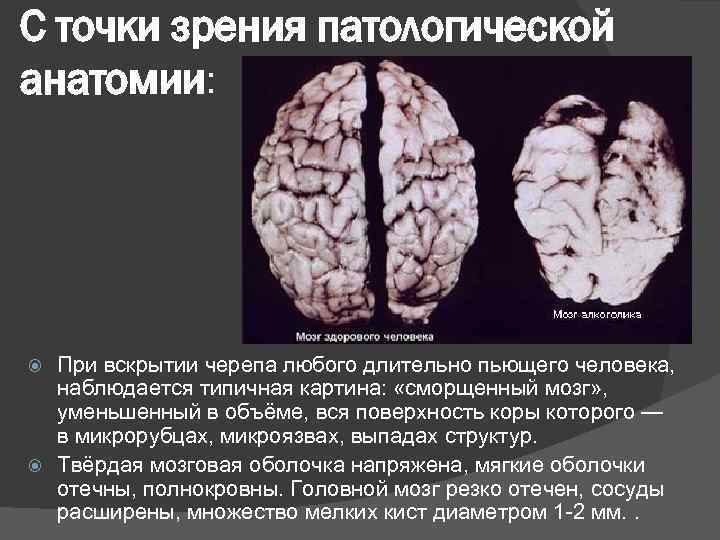 С точки зрения патологической анатомии: При вскрытии черепа любого длительно пьющего человека, наблюдается типичная