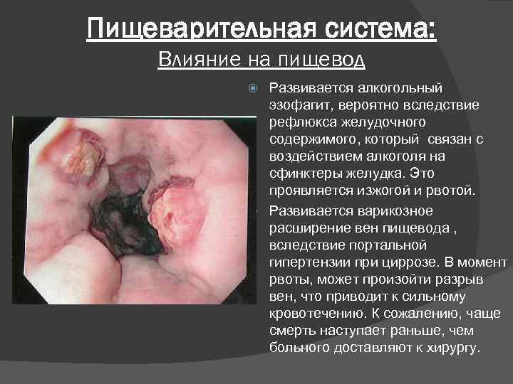 Пищеварительная система: Влияние на пищевод Развивается алкогольный эзофагит, вероятно вследствие рефлюкса желудочного содержимого, который